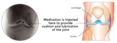 Medication injected here to provide cushion and lubrication of the joint