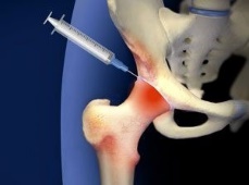 Joint injection in hip