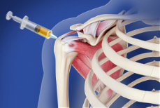 Joint injection in shoulder